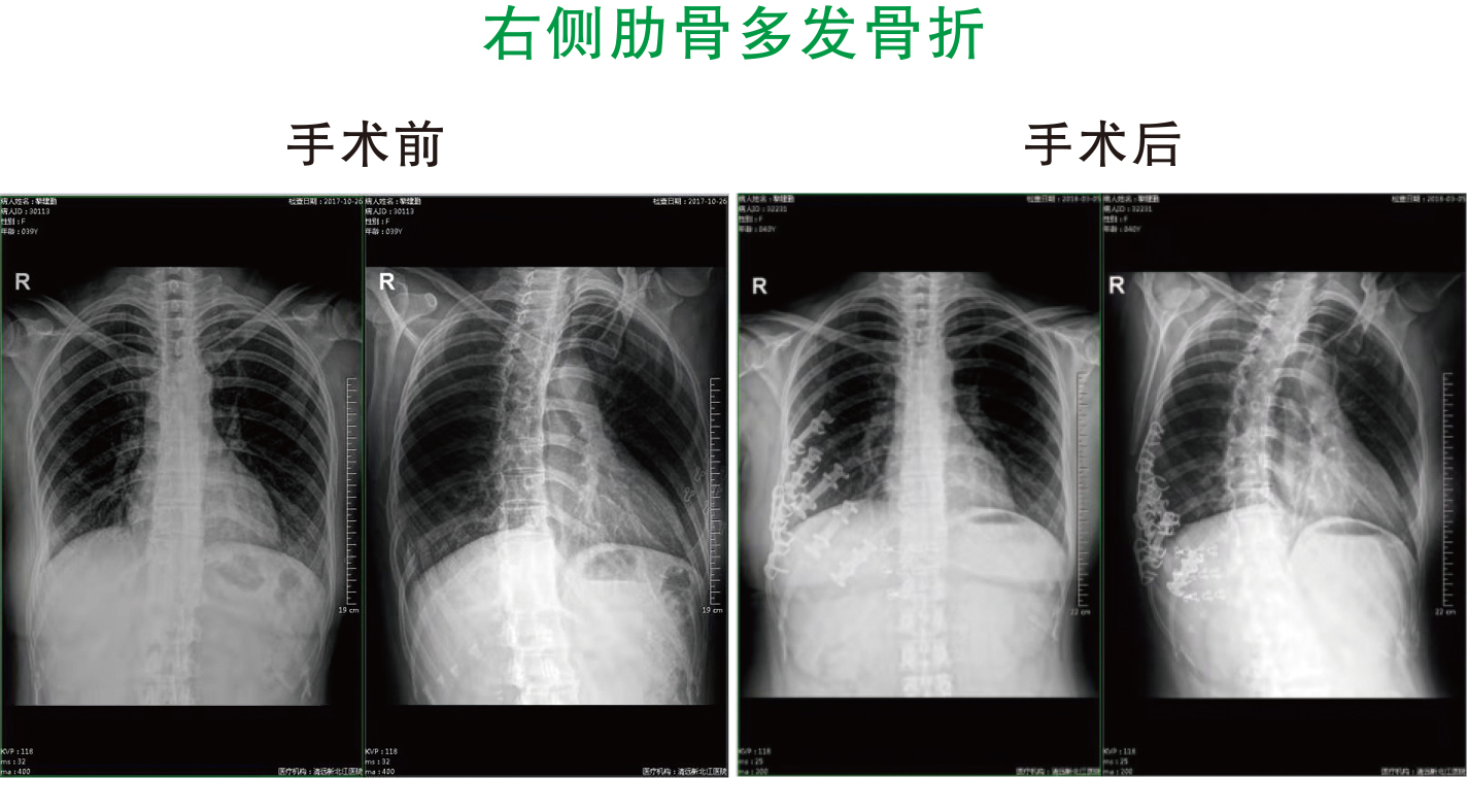 右侧肋骨多发骨折