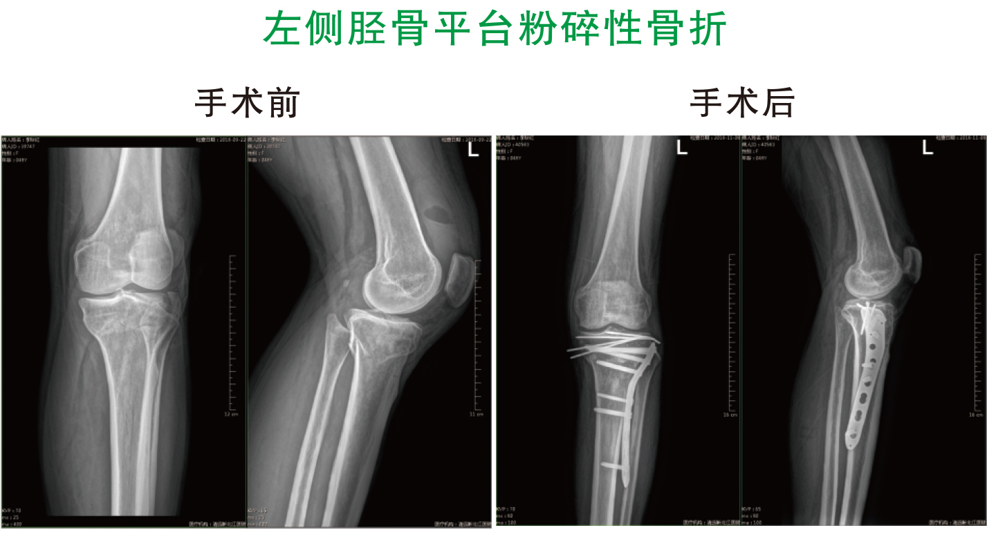 左侧胫骨平台粉碎性骨折
