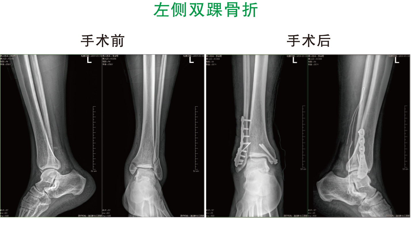 左侧双踝骨折