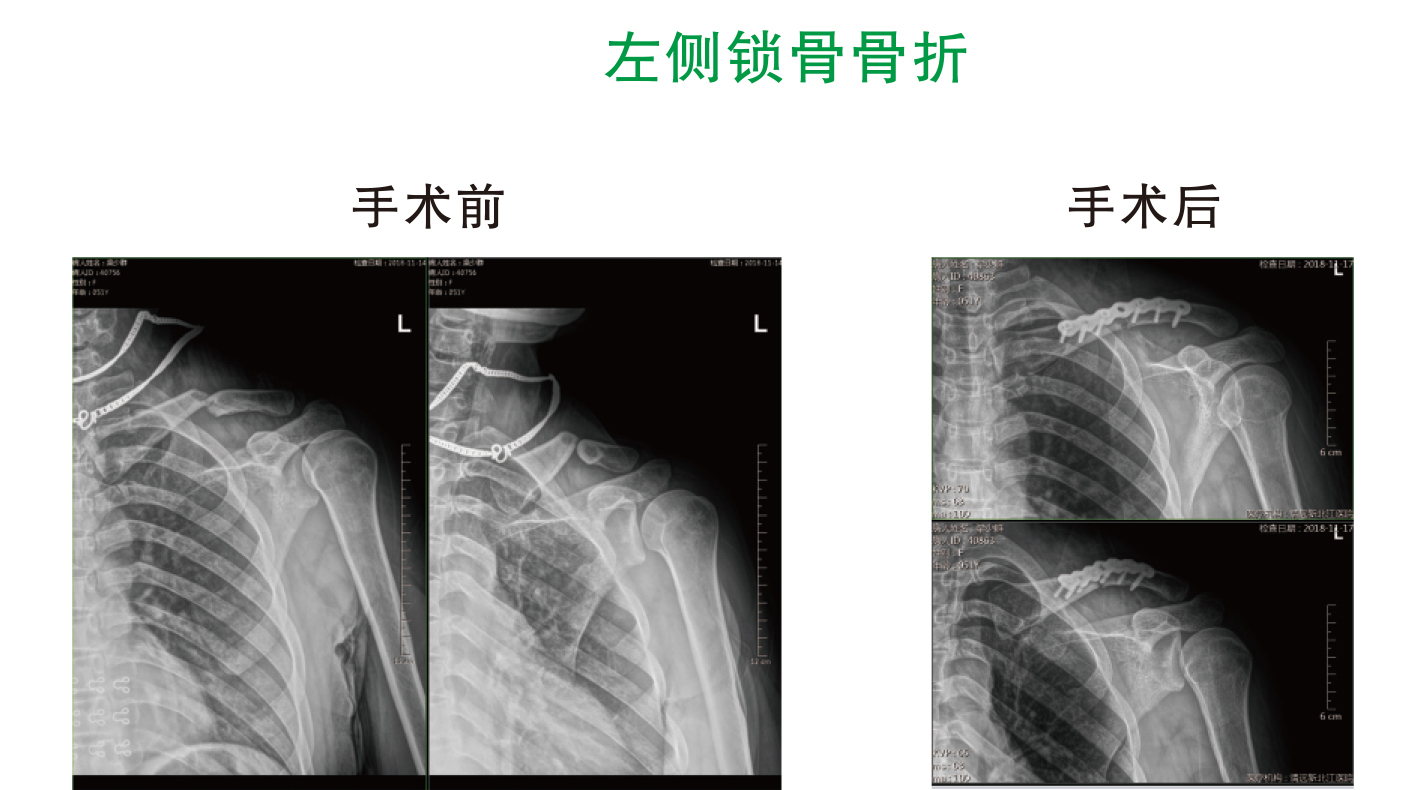 左侧锁骨骨折