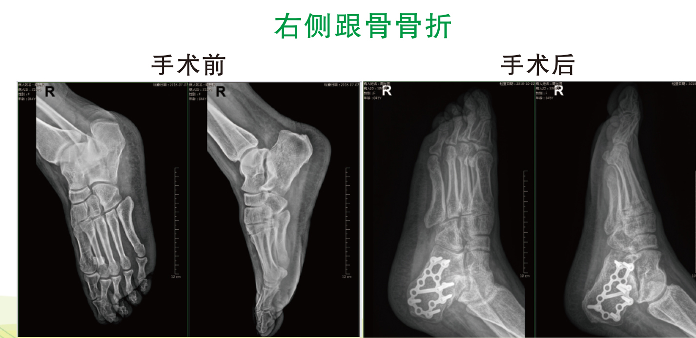 右侧跟骨骨折