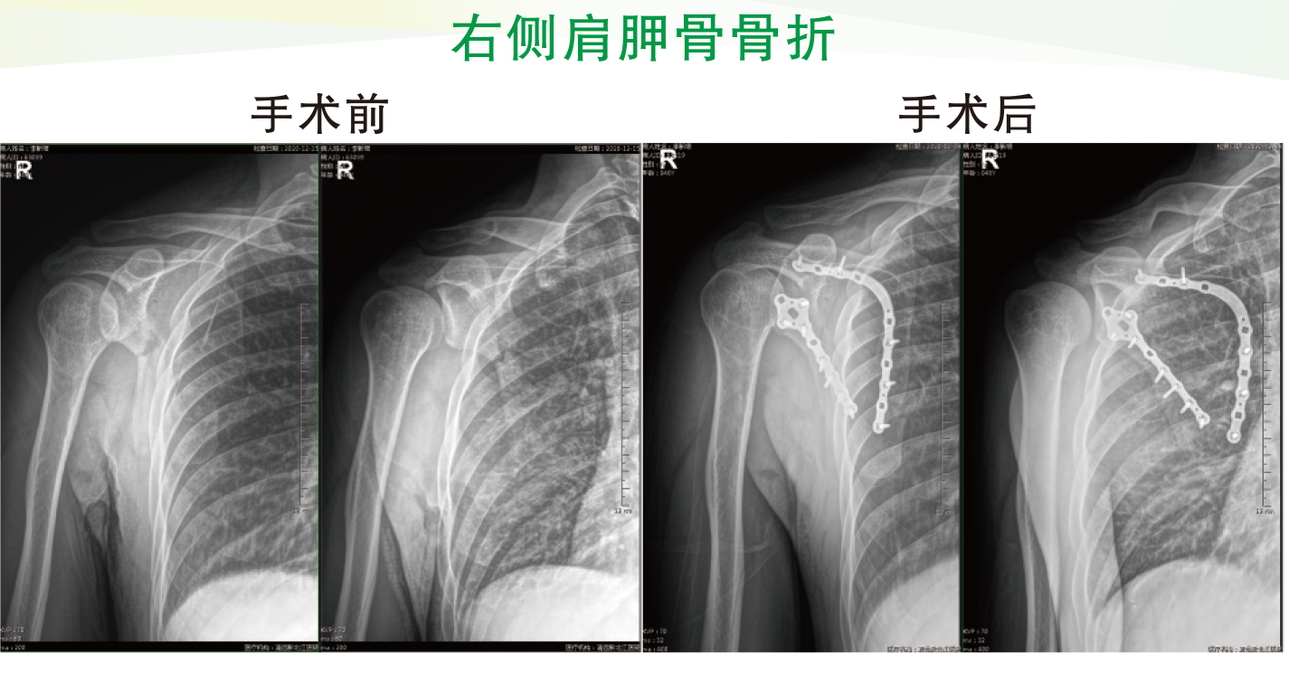 右侧肩胛骨骨折