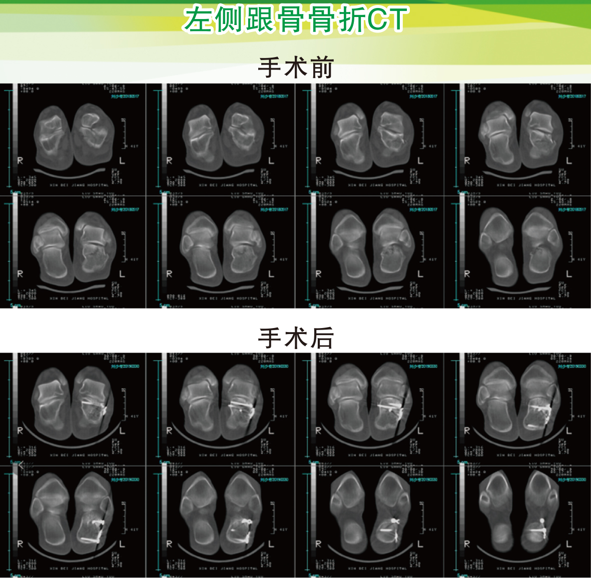 左侧跟骨骨折CT